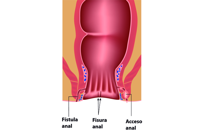 Fisura de ano