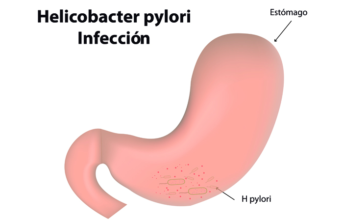 Bacteria del estomago helicobacter pylori tratamiento