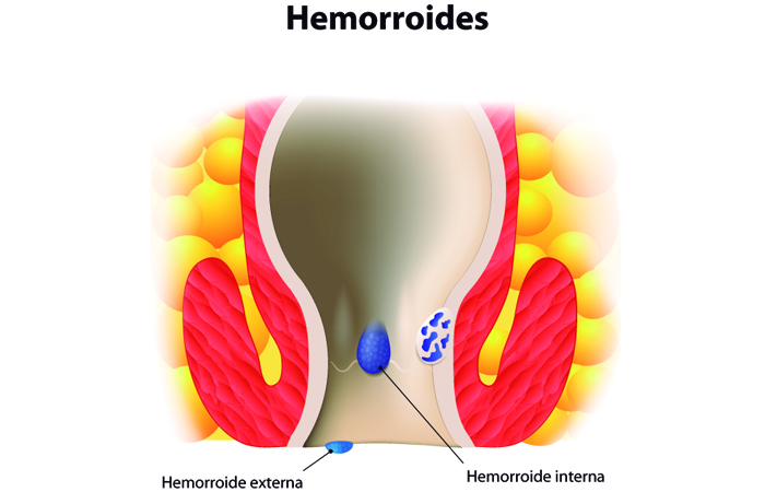 Hemorroides