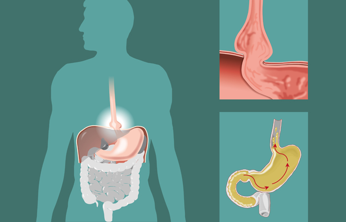 Hernia de Hiato